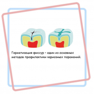 Профилактика кариеса - герметизация фиссур