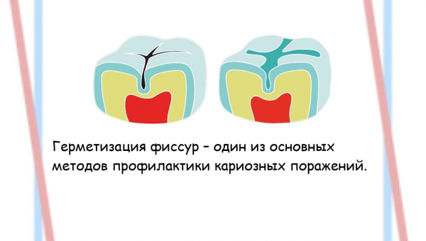 Профилактика кариеса - герметизация фиссур