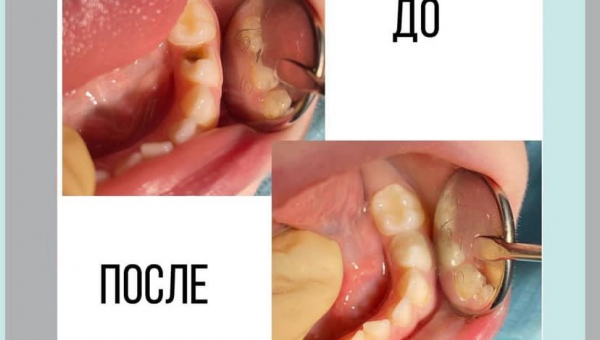 Ценность молочных зубов велика!